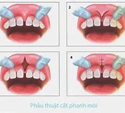 Cắt Thắng Lưỡi Là Gì