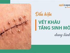 Vết Khâu Tầng Sinh Môn Tiếng Anh